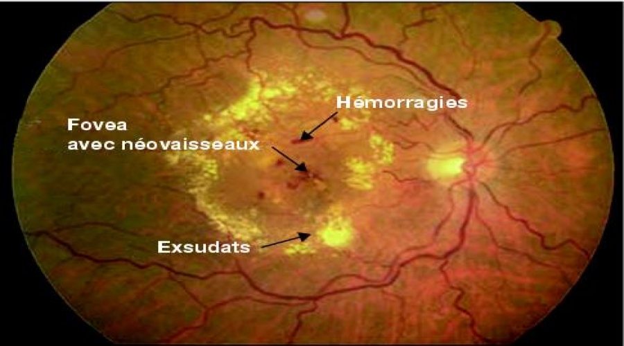 Les dégénérescences maculaires